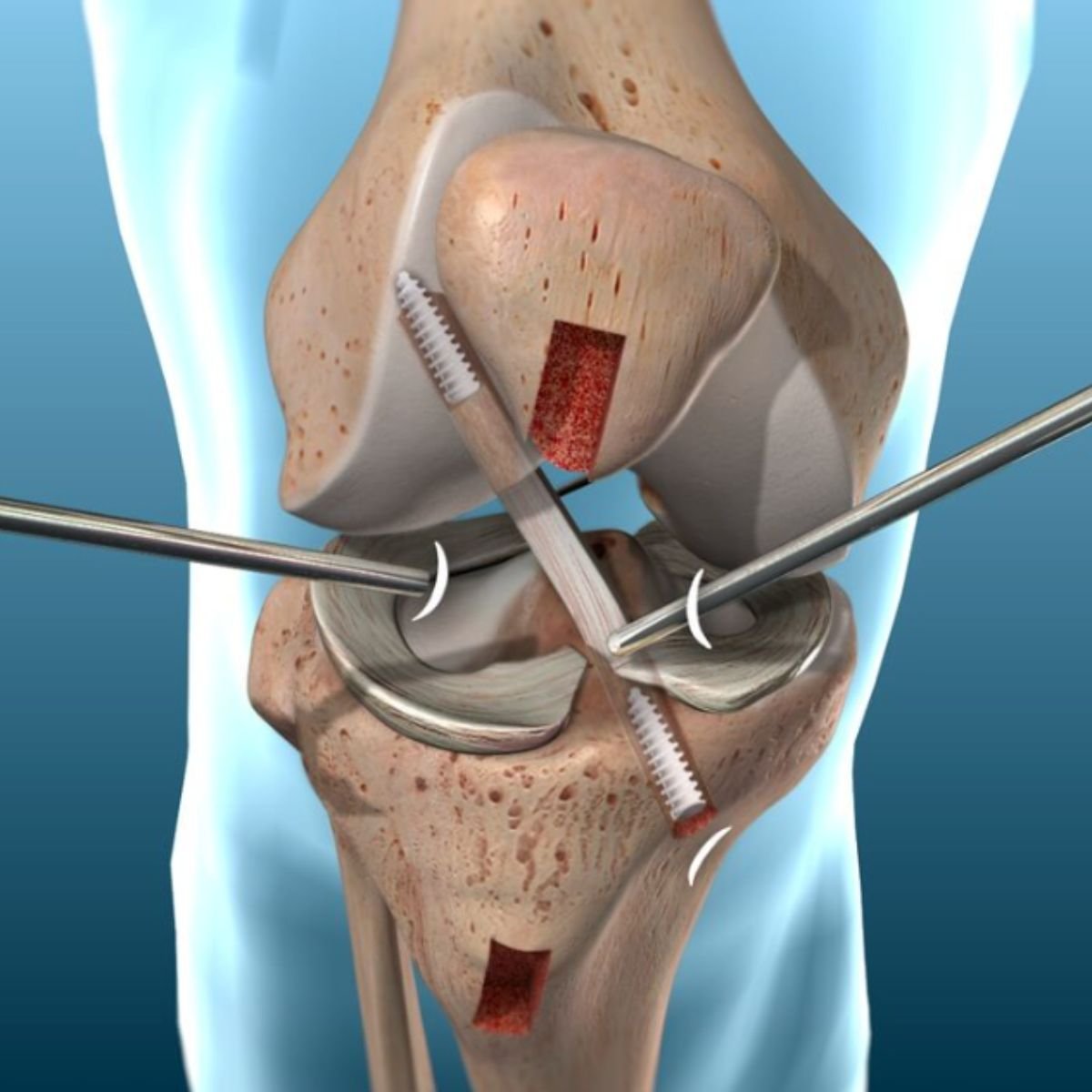 ACL and PCL