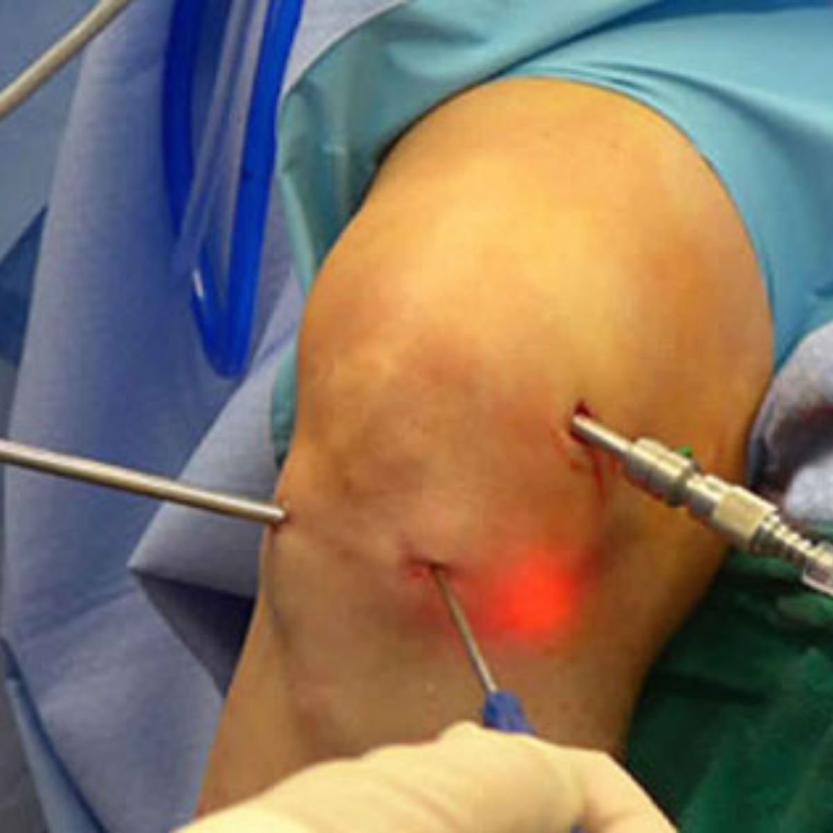 Arthroscopy