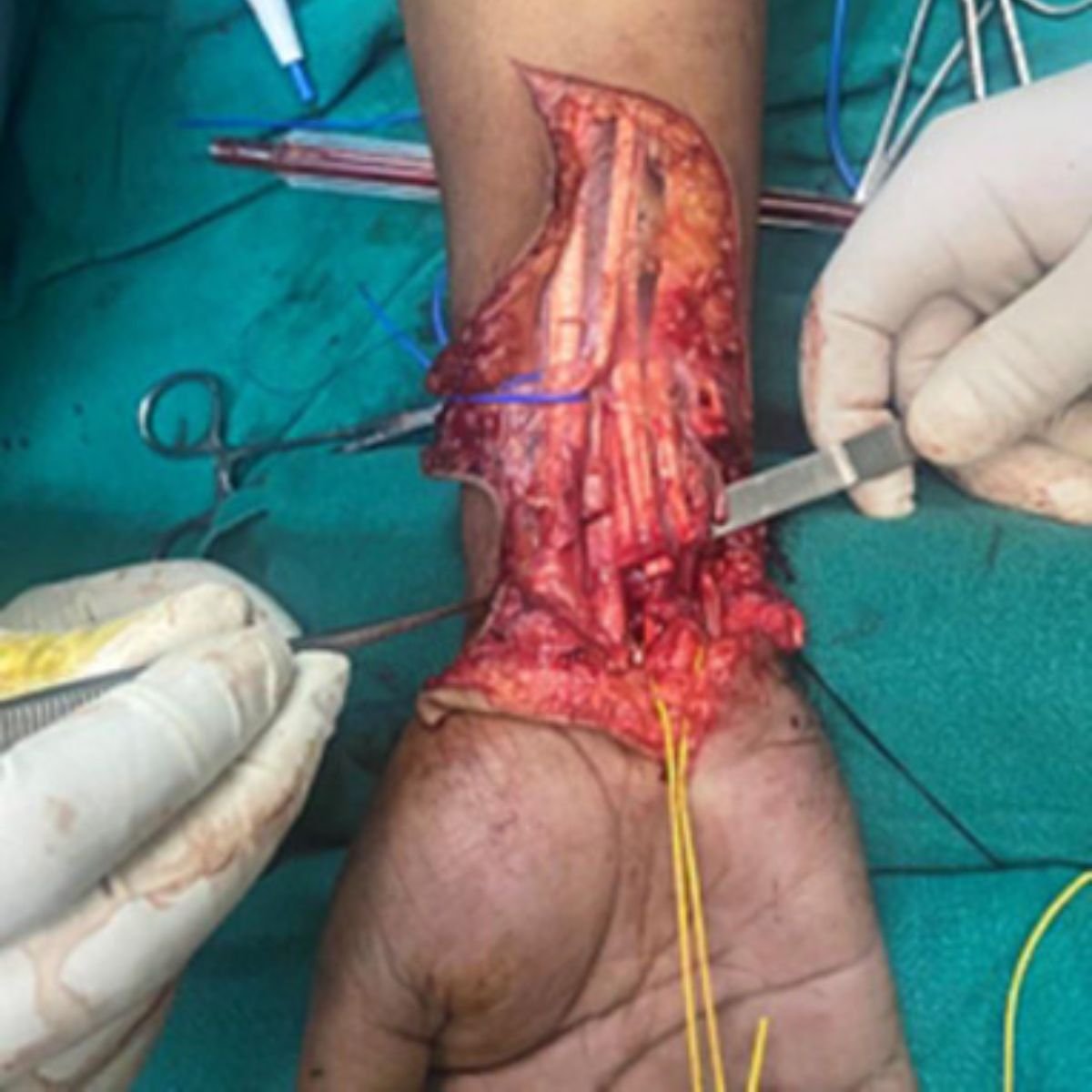 Tendon Injury