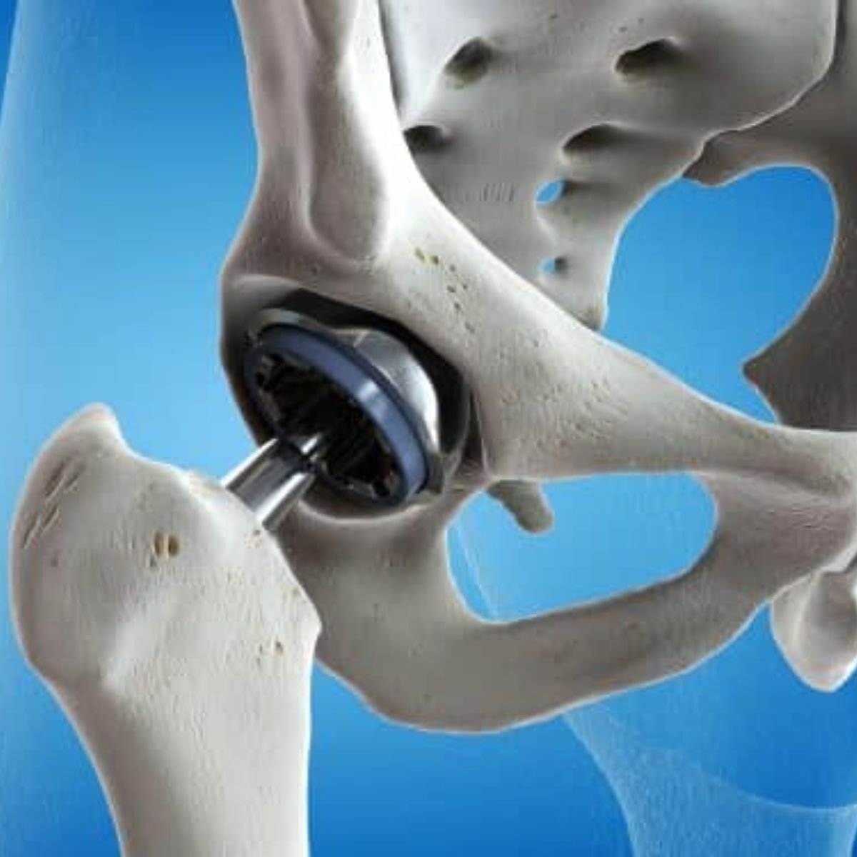 Replacement Surgery